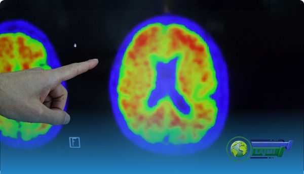 Dy kopje të gjenit të rrezikut do të thotë se ju do të sëmureni nga Alzheimeri